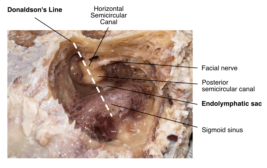 Donaldson's Line Temporal Bone Dissection
