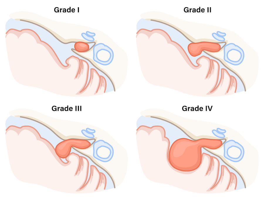 Koos Classification of Vestibular Schwannomas