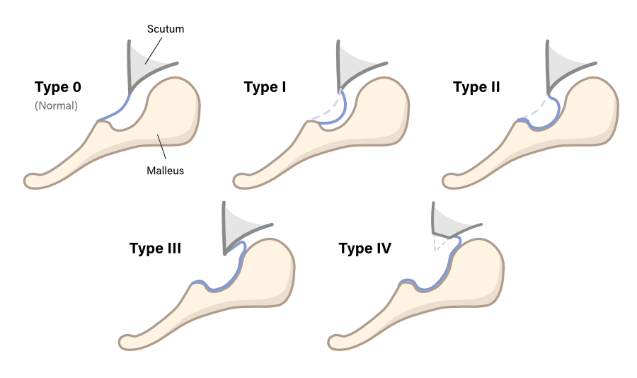 Tos and Poulsen classification of pars flaccida retraction